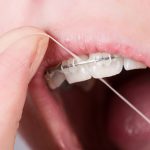 CARING FOR YOUR BRACES